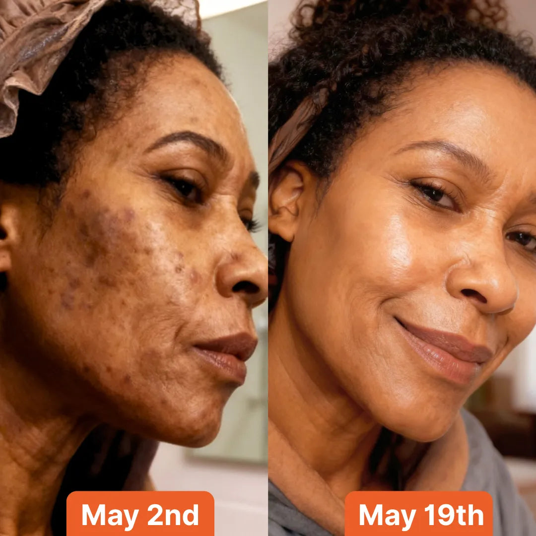 Anti-Dark Spots & Acne African Black Soap