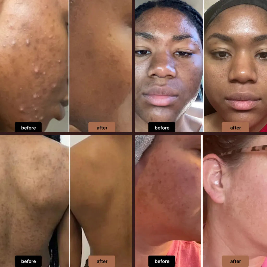 Anti-Acne & Dark Spots African Soap