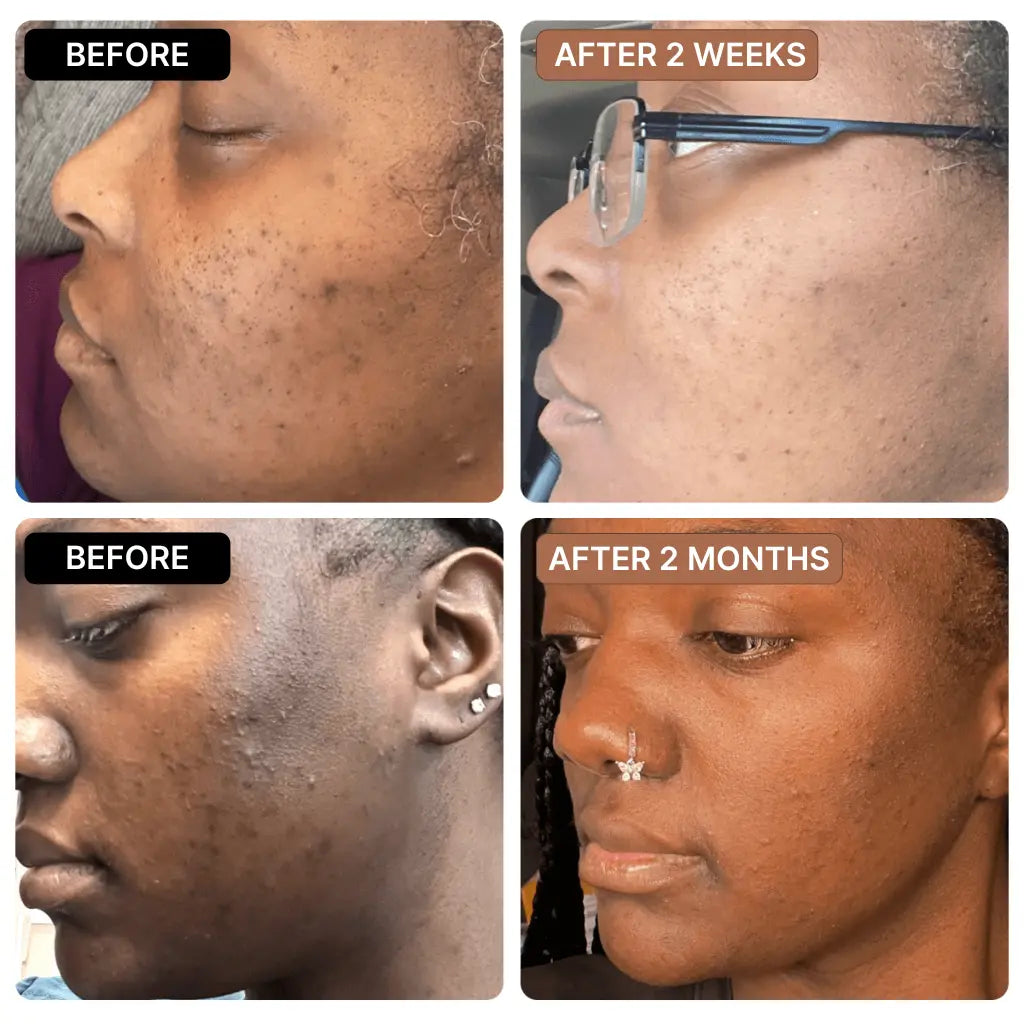 Anti-Acne & Dark Spots African Soap