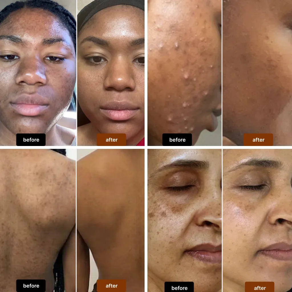Anti-Acne & Dark Spots African Soap