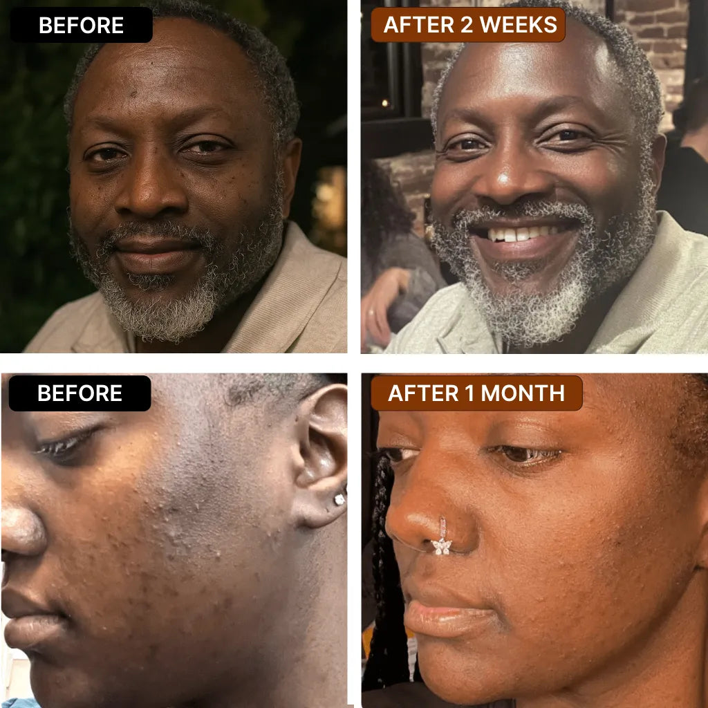 Anti-Acne & Dark Spots African Soap