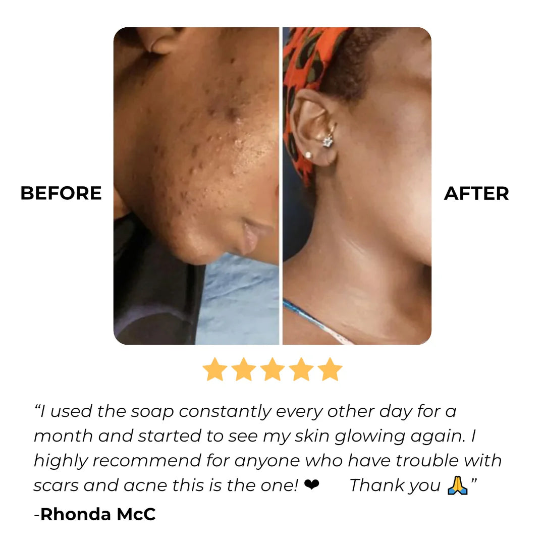 Anti-Acne & Dark Spots African Soap